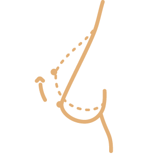 Mamoplastia 
